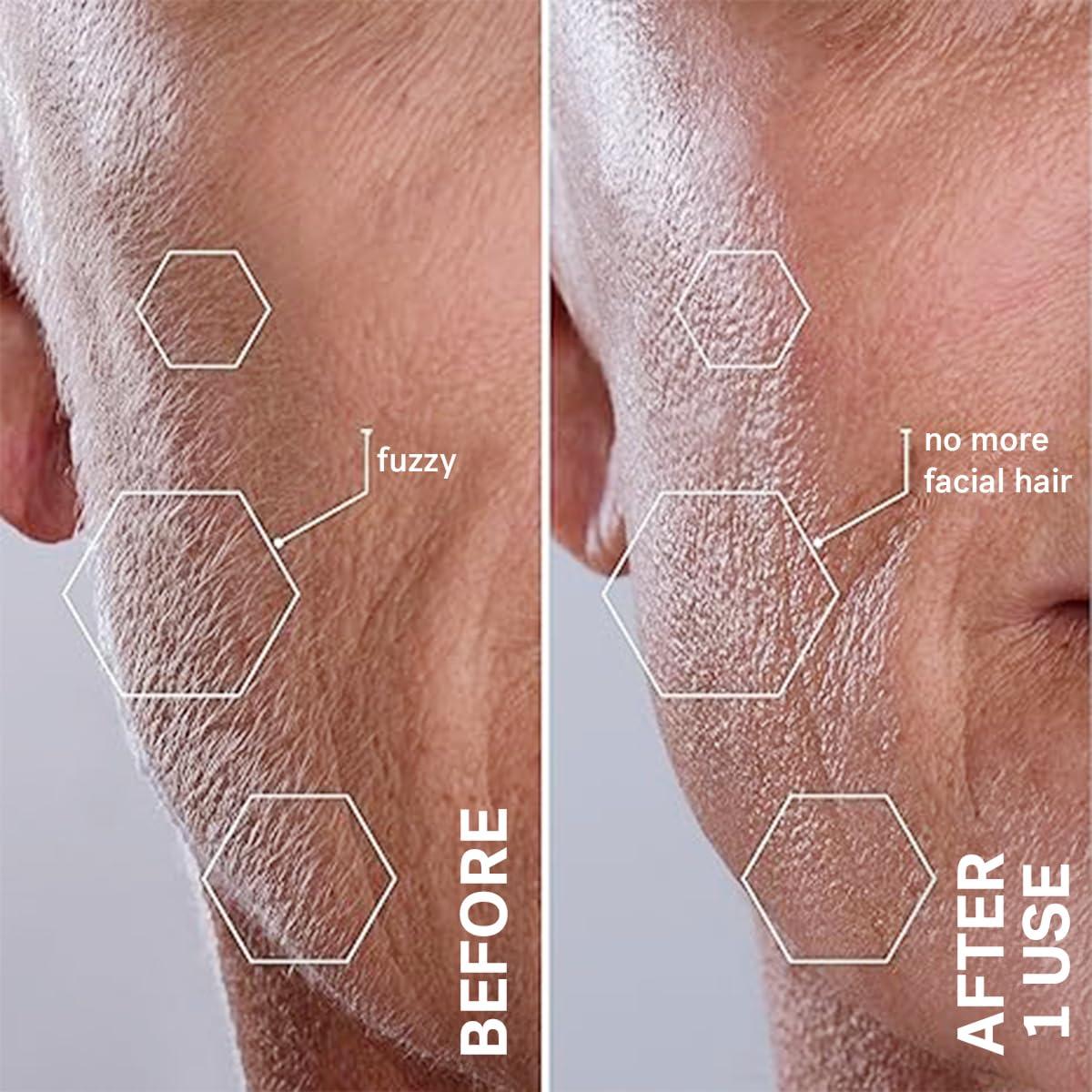 image:imageMichael Todd Beauty Sonicsmooth Dermaplane Razor for Women Face Eyebrow trimmer Dermaplaning System Peach Fuzz Remover 8 Weeks of Dermaplaning BladesPink