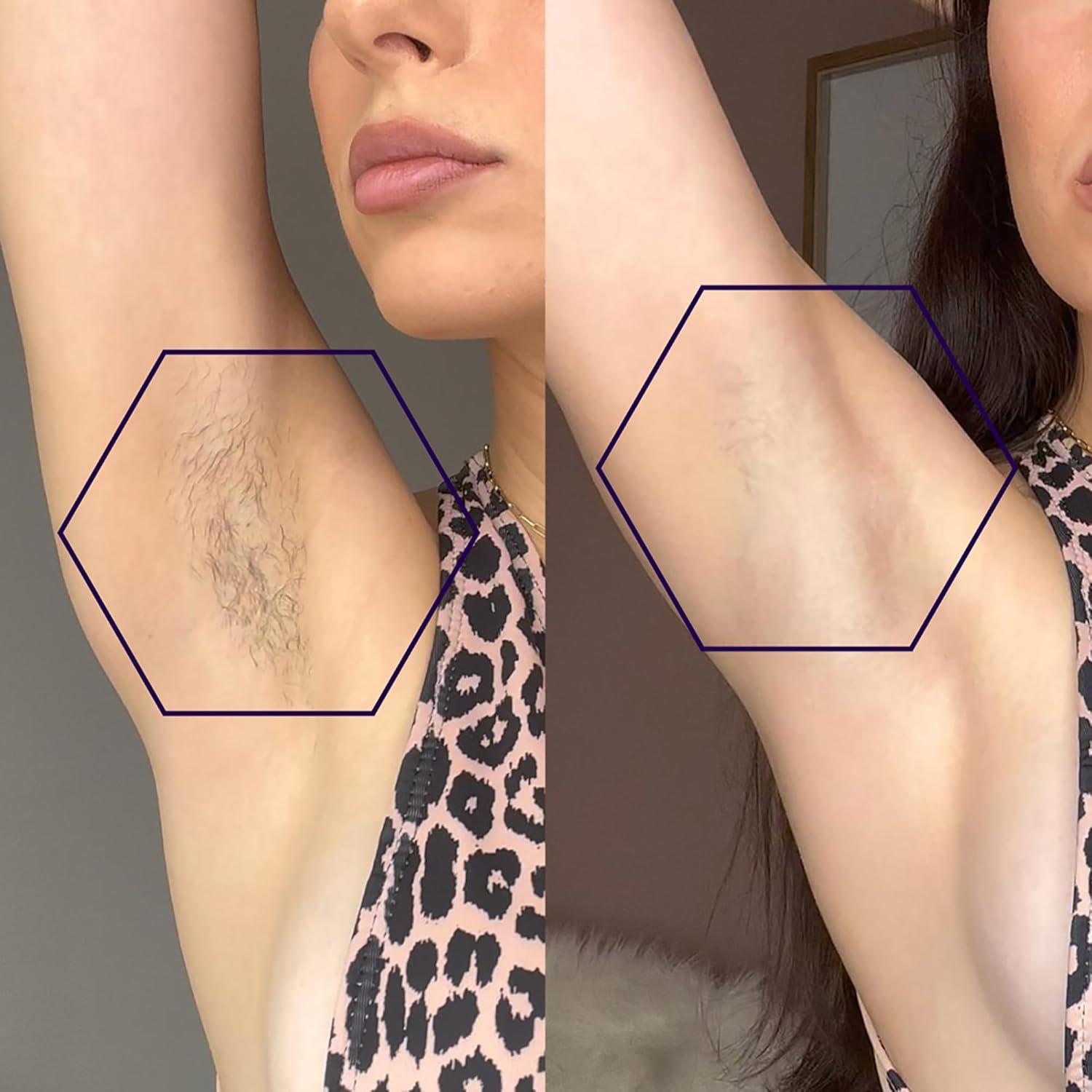 image:imageMICHAEL TODD BEAUTY LUMOS Laser IPL Hair Removal for Women and Men 50F CoolMax Technology 999999 flashes 3 In 1 wSkin Sensor for Nearly Painless Permanent hair removalLavender